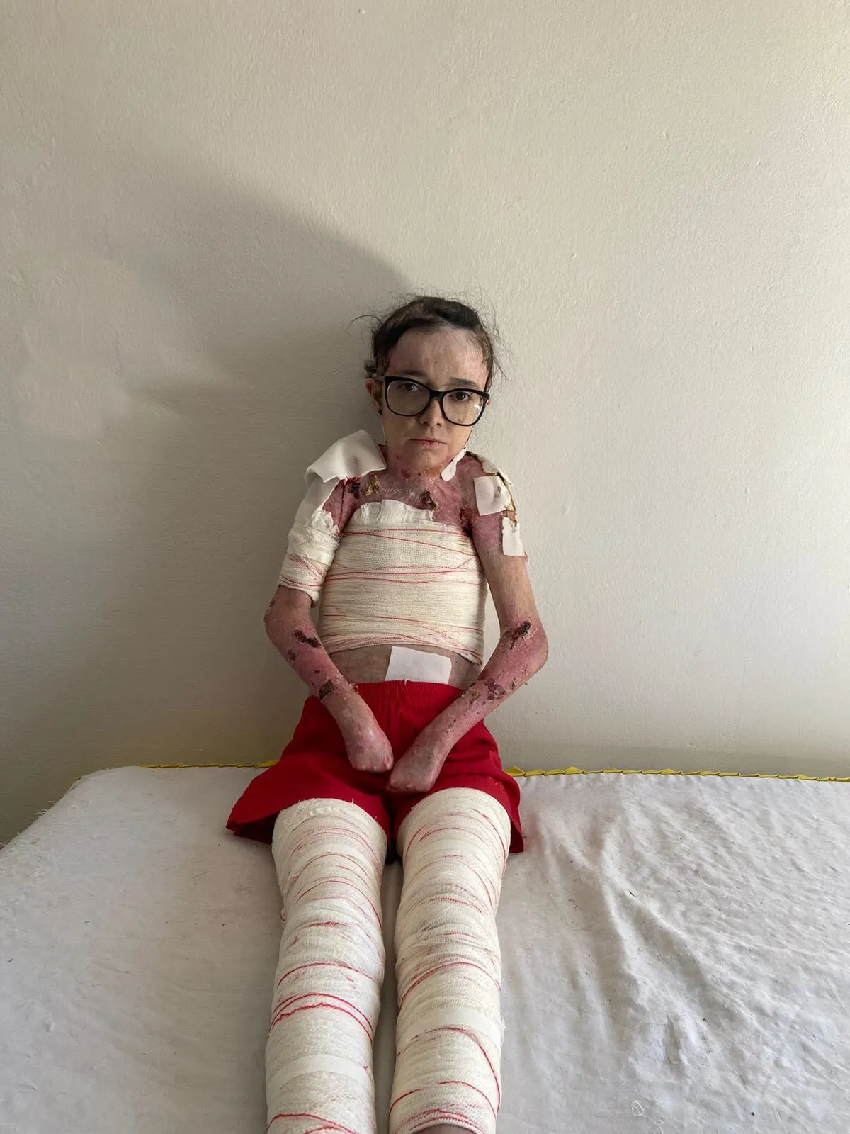 Amara sitting on her bed with fresh dressings covering her arms and legs